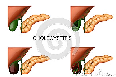 Liver, gall bladder and pancreas. cholecystitis Vector Illustration