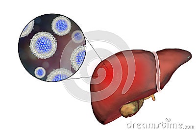 Liver with Hepatitis C infection and close-up view of Hepatitis C Virus Cartoon Illustration