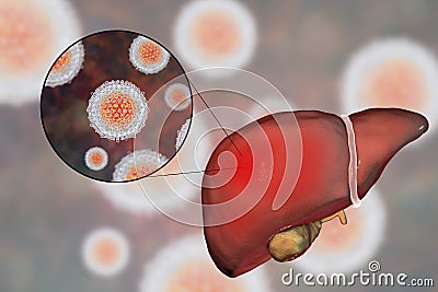 Liver with Hepatitis C infection and close-up view of Hepatitis C Virus Cartoon Illustration