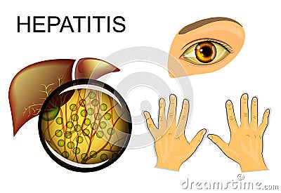 Liver, hepatitis and yellowing of eyes and hands Vector Illustration