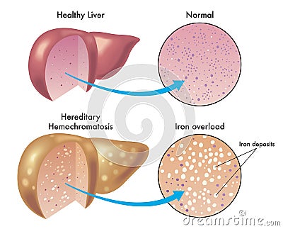 Liver with hereditary hemochromatosis Vector Illustration