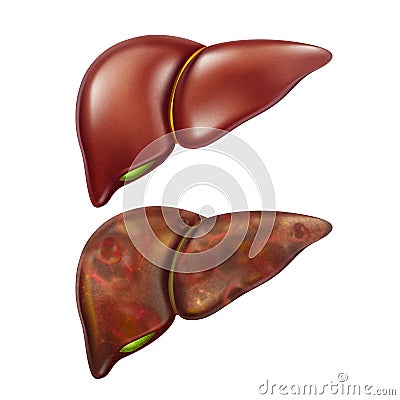 Liver Human Healthy And Unhealthy Organ Set Vector Vector Illustration