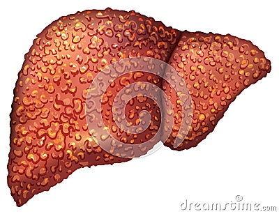 Liver patients with hepatitis. Liver is sick person. Cirrhosis of liver. Repercussion alcoholism Vector Illustration