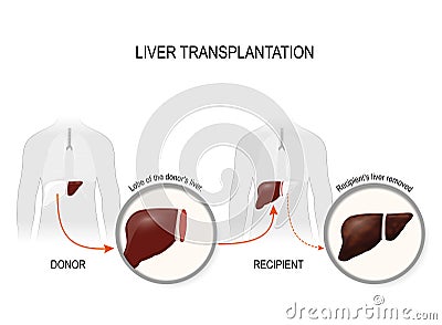 Liver transplantation or hepatic transplantation Vector Illustration