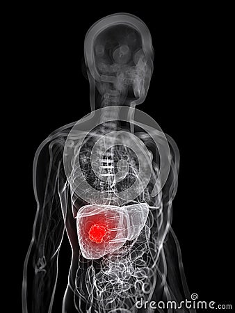 Liver tumor Cartoon Illustration