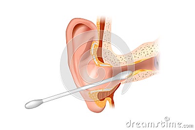 llustration of the ear canal being cleaned with a cotton swab. Section of the ear with the cerumen. Removing earwax and Vector Illustration