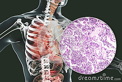 Lobar pneumonia, grey hepatic phase Cartoon Illustration