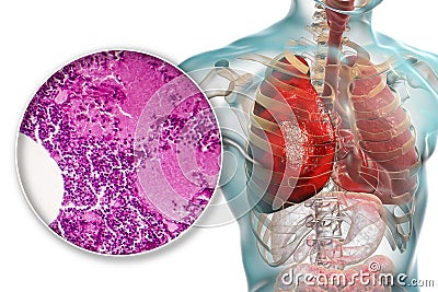 Lobar pneumonia, hemorrhagic edema period Cartoon Illustration