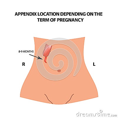 The location of the appendix depends on the term of pregnancy. 8-9 months. Infographics. Vector illustration Vector Illustration