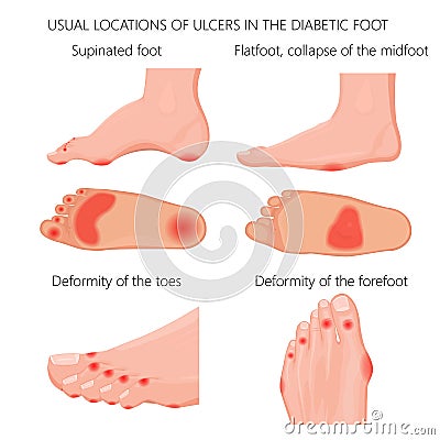 Location of the Diabetic foot ulcers Vector Illustration