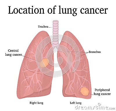 Location of lung cancer Vector Illustration