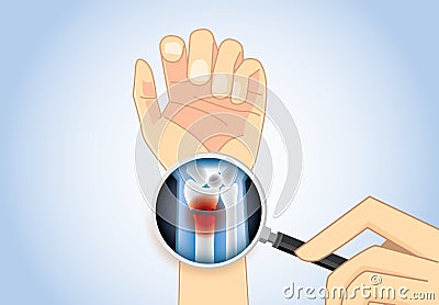 Looking inner wrist fracture with Magnifier. Vector Illustration
