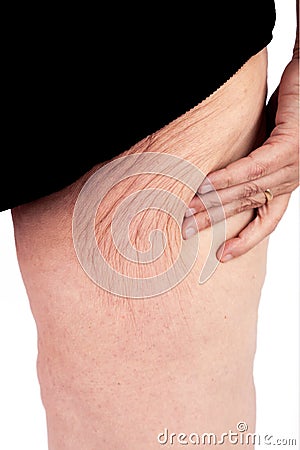 Skin suit - Extreme Weight Loss Stock Photo