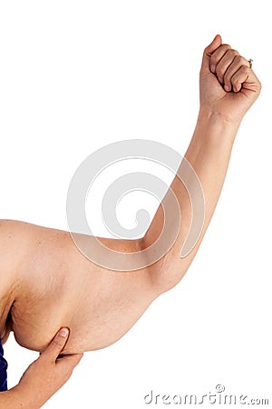 Skin suit - Extreme Weight Loss Stock Photo