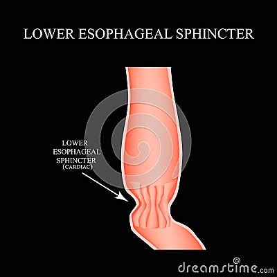 Lower cardiac esophageal sphincter. Infographics. Vector illustration on black background. Vector Illustration