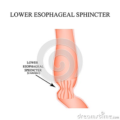 Lower cardiac esophageal sphincter. Infographics. Vector illustration on isolated background. Vector Illustration