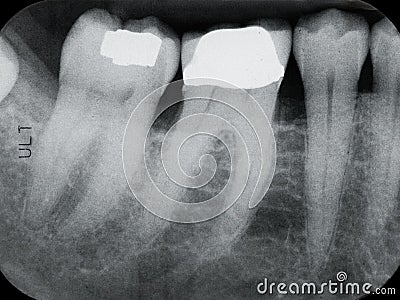 Lower Left Periodontal X-rays Stock Photo