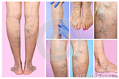 Lower limb vascular examination because suspect of venous insufficiency. Stock Photo