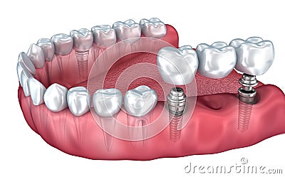 Lower teeth and dental implant transparent render isolated on white Cartoon Illustration
