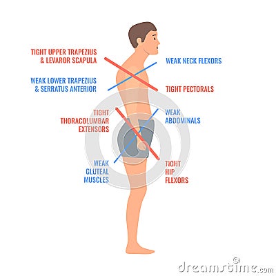 Lower and upper crossed syndrome body diagram Vector Illustration