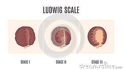 Ludwig scale of baldness in women infographics Vector Illustration