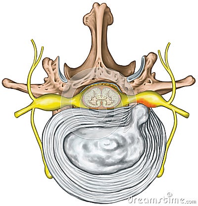 Lumbar disk herniation, nerve root Stock Photo