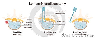 Lumbar microdiscectomy. Spinal disc herniation surgery. Removing Vector Illustration