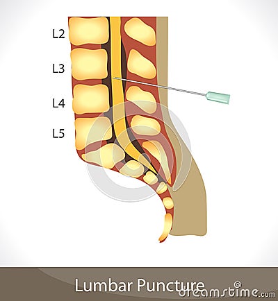 Lumbar puncture Vector Illustration