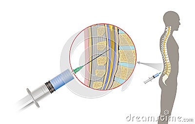Lumbar puncture also known as a spinal tap, is a medical procedure in which a needle is inserted into the spinal canal. Cerebrospi Stock Photo