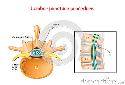 Lumbar puncture procedure Vector Illustration