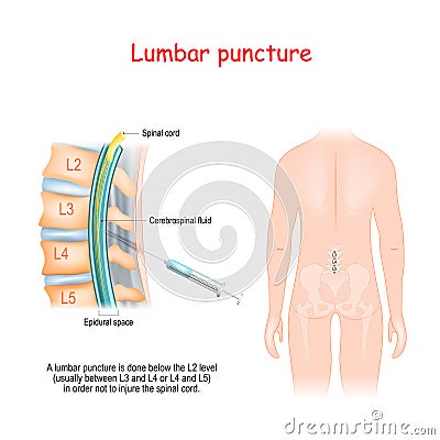 Lumbar Puncture. Spinal Tap Procedure. Syringe needle inserted into Epidural space Vector Illustration