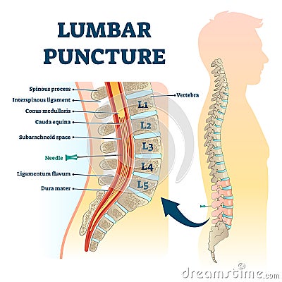 Lumbar puncture vector illustration. Labeled spine structure procedure scheme Vector Illustration