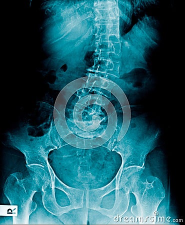 Scoliosis lumbar x-ray image Stock Photo