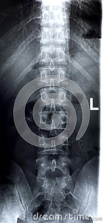 Lumbar spine/Front Stock Photo