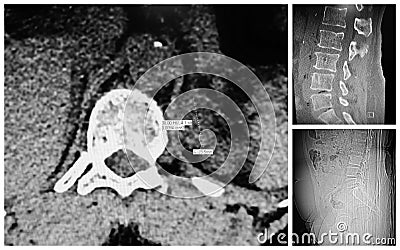 Lumbar spine moderate disc extrusion ct collage Stock Photo