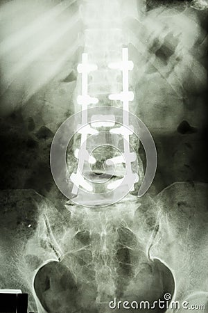 Lumbar spine with pedicle fixation Stock Photo