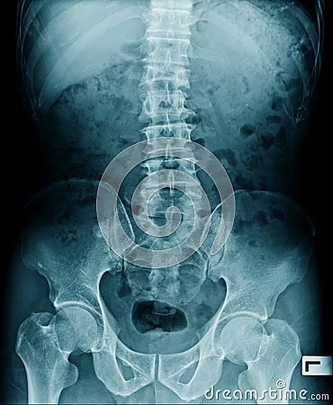 lumbar spine x-ray image Stock Photo