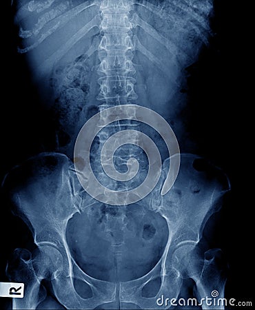 x-ray spine and pelvic bone Stock Photo