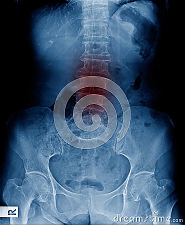 Lumbar spur and scoliosis and spondylosis Stock Photo