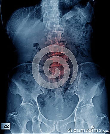 Lumbar spur and scoliosis Stock Photo