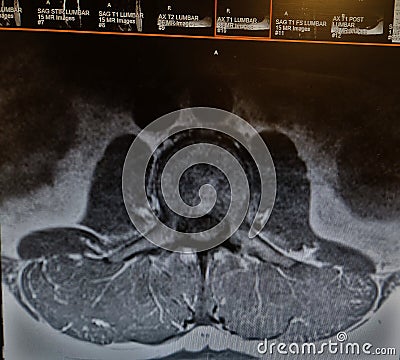 Lumbar transverse CT showing human T-bone steaks Stock Photo