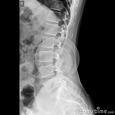 lumbosacral spine x-ray lateral view Stock Photo