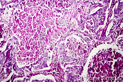 Lung adenocarcinoma, light micrograph Stock Photo