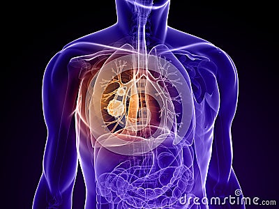 Lung cancer