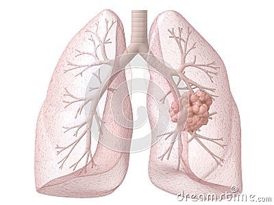 Lung Cancer Royalty Free Stock Photo - Image: 5564055