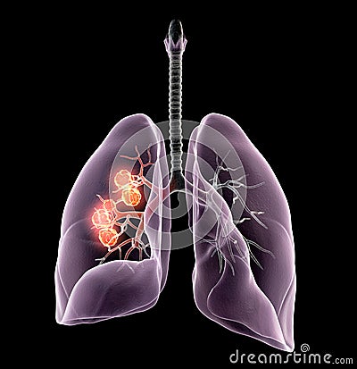 Lung cancer or bronchial carcinoma, 3D medically illustration on black background Cartoon Illustration