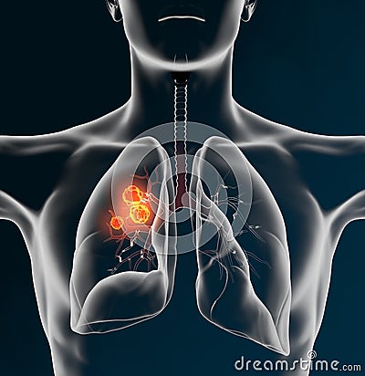 Lung cancer or bronchial carcinoma of a man, 3D medically illustration on black background Cartoon Illustration