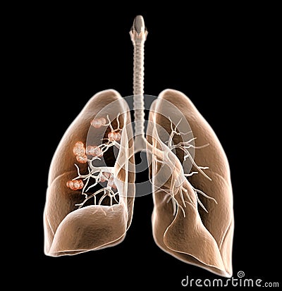 Lung cancer or bronchial carcinoma, medically 3D illustration Cartoon Illustration