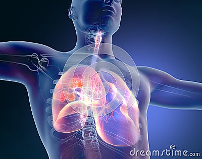 Lung cancer or bronchial carcinoma, medically illustration 3D Cartoon Illustration