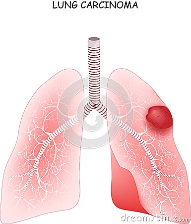 Lung cancer. carcinoma is a malignant lung tumor Vector Illustration